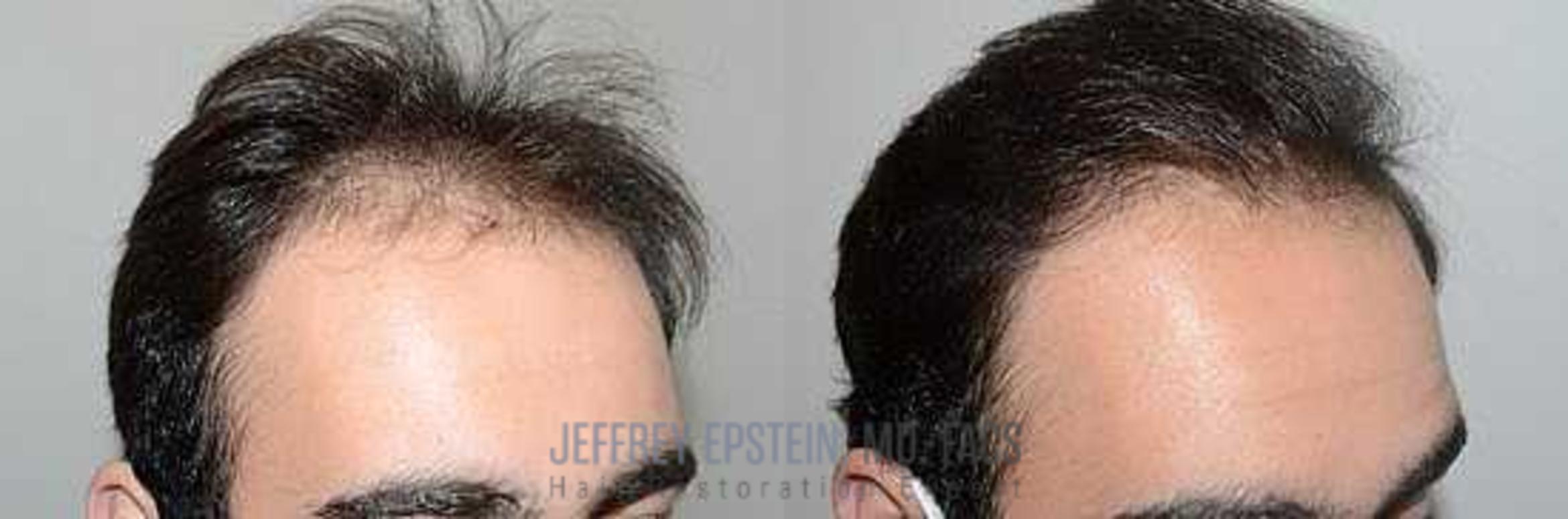Before & After Hair Transplants For Men Case 88 View 3 View in Miami, FL