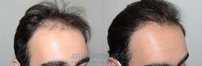 Before & After Hair Transplants For Men Case 88 View 3 View in Miami, FL