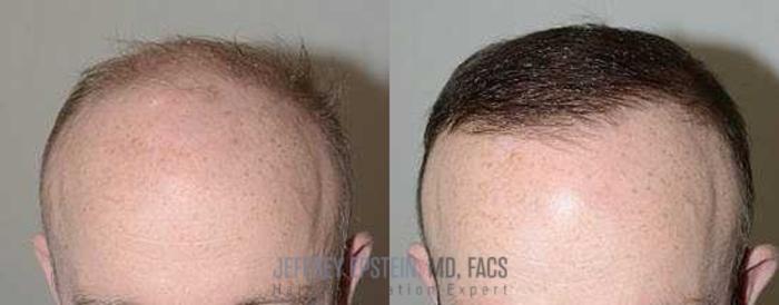 Before & After Body Hair Transplant (BHT) Case 90 View 1 View in Miami, FL