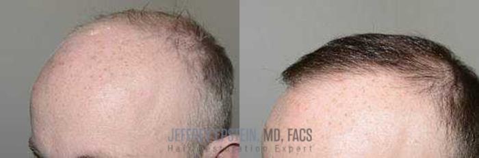 Before & After Hair Transplants For Men Case 90 View 2 View in Miami, FL