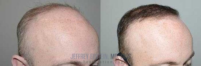 Before & After Hair Transplants For Men Case 90 View 3 View in Miami, FL