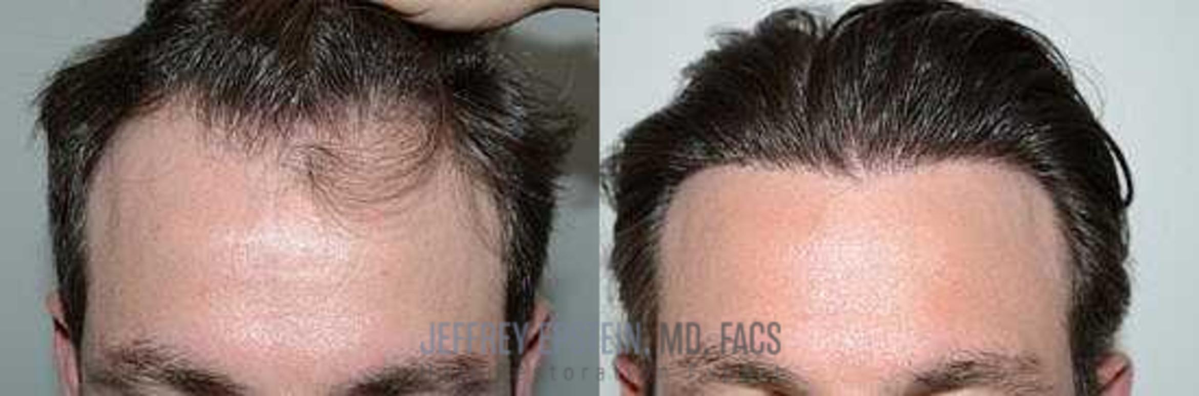 Before & After Hair Transplants For Men Case 91 View 1 View in Miami, FL