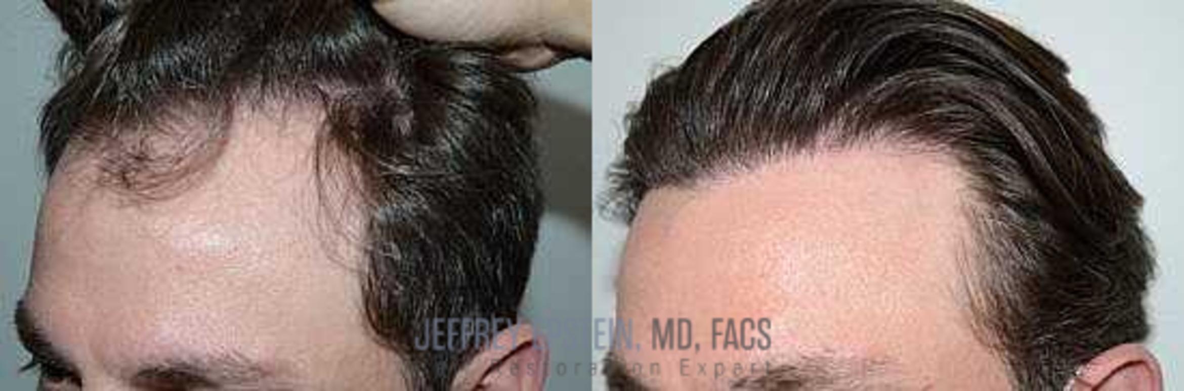 Before & After Hair Transplants For Men Case 91 View 2 View in Miami, FL