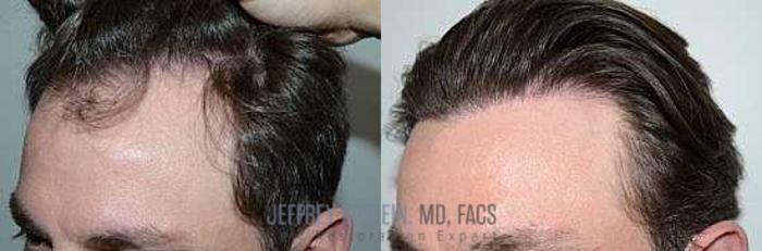 Before & After Hair Transplants For Men Case 91 View 2 View in Miami, FL