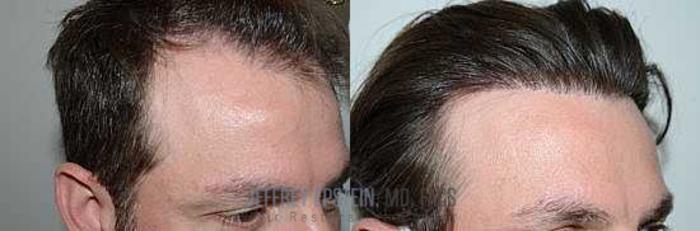 Before & After Hair Transplants For Men Case 91 View 3 View in Miami, FL