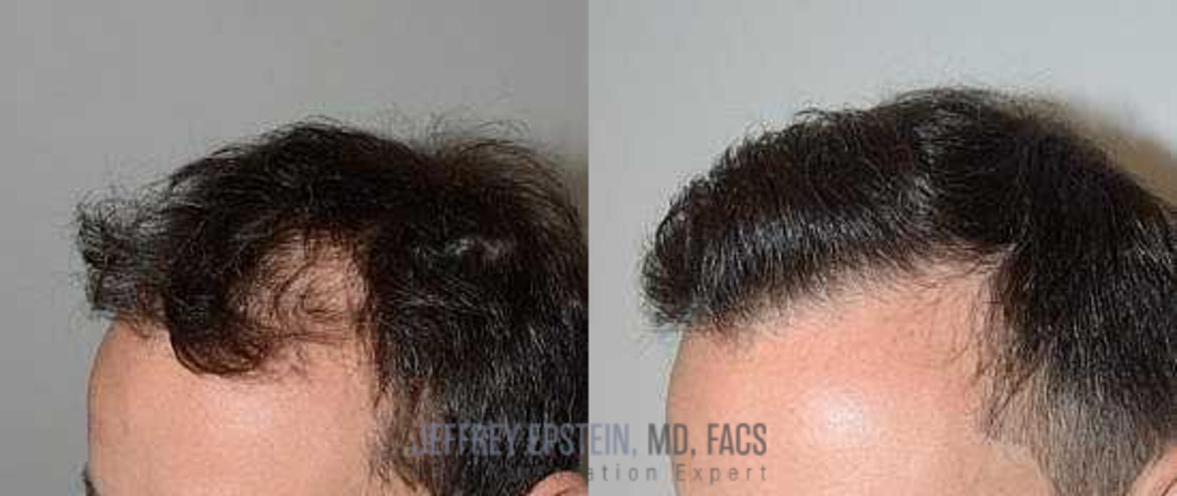 Before & After Hair Transplants For Men Case 92 View 1 View in Miami, FL