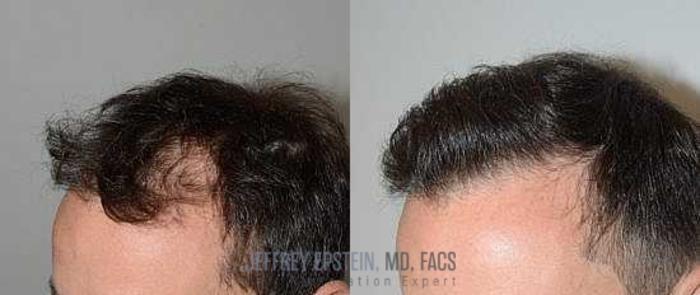 Before & After Hair Transplants For Men Case 92 View 1 View in Miami, FL