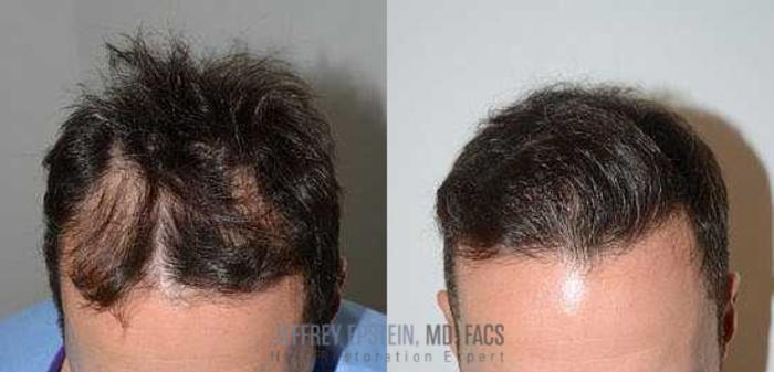 Before & After Hair Transplants For Men Case 92 View 2 View in Miami, FL