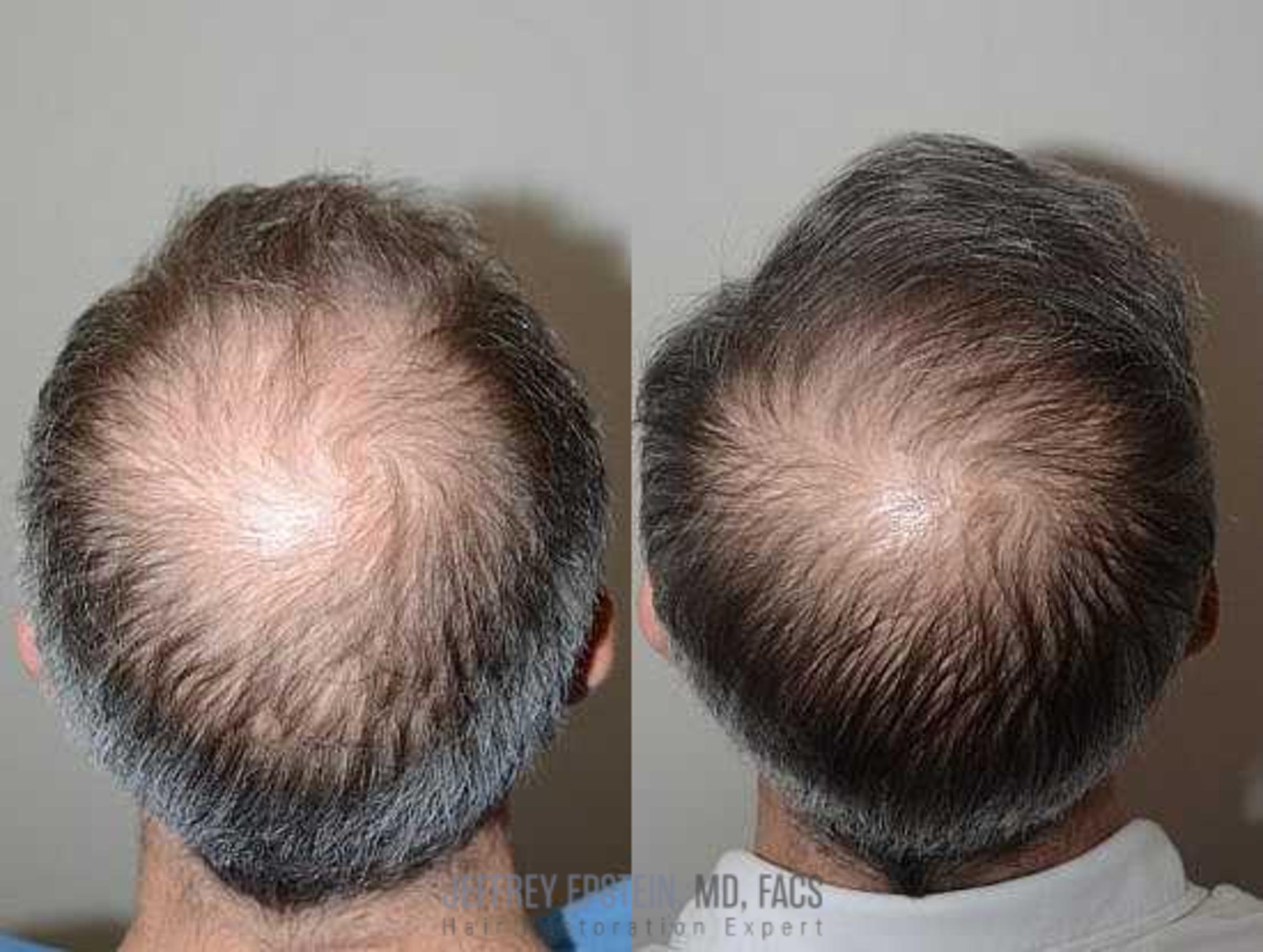 Before & After Hair Transplants For Men Case 93 View 1 View in Miami, FL