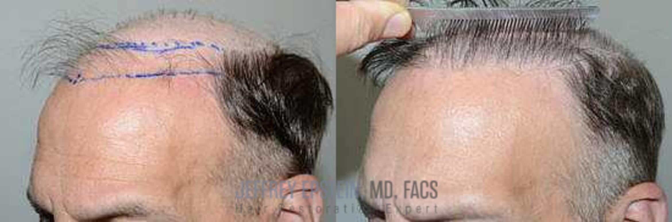 Before & After Hair Transplants For Men Case 94 View 1 View in Miami, FL