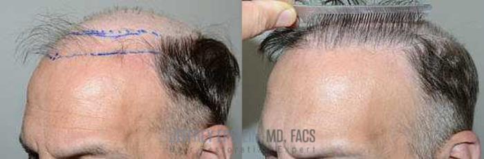 Before & After Hair Transplants For Men Case 94 View 1 View in Miami, FL