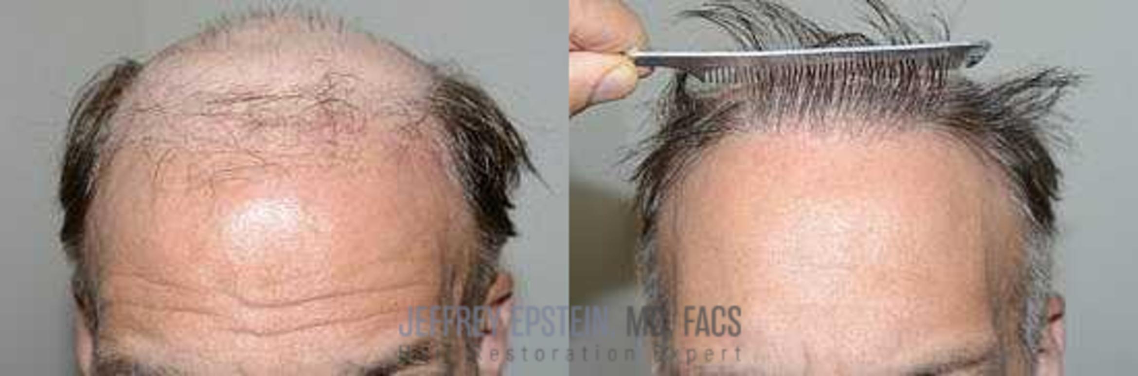 Before & After Hair Transplants For Men Case 94 View 2 View in Miami, FL