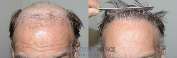 Before & After Hair Transplants For Men Case 94 View 2 View in Miami, FL