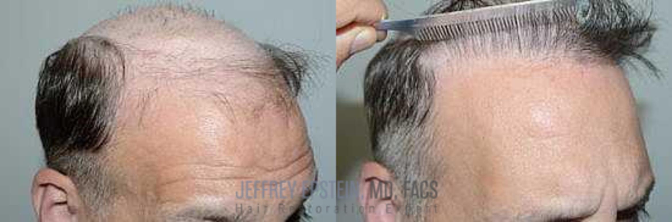 Before & After Hair Transplants For Men Case 94 View 3 View in Miami, FL