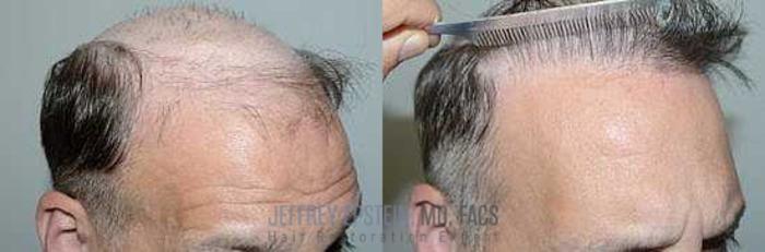 Before & After Hair Transplants For Men Case 94 View 3 View in Miami, FL