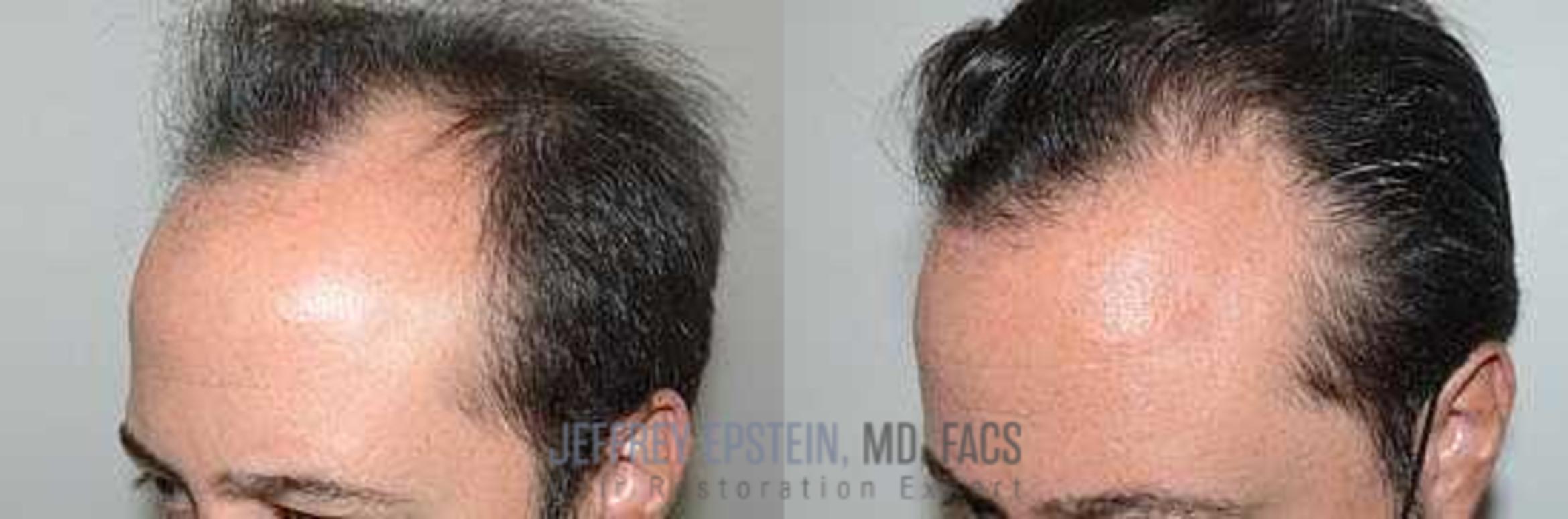 Before & After Hair Transplants For Men Case 95 View 1 View in Miami, FL