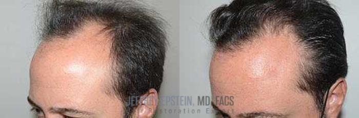 Before & After Hair Transplants For Men Case 95 View 1 View in Miami, FL