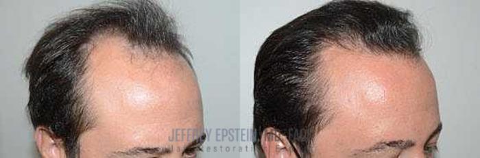 Before & After Hair Transplants For Men Case 95 View 2 View in Miami, FL