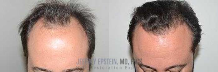 Before & After Hair Transplants For Men Case 95 View 3 View in Miami, FL