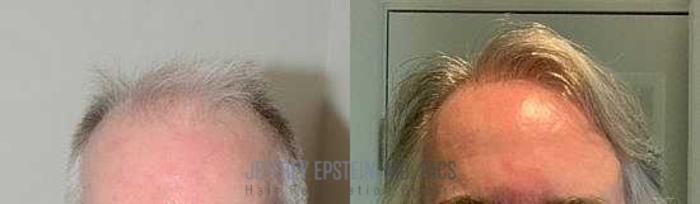 Before & After Hair Transplants For Men Case 97 View 1 View in Miami, FL