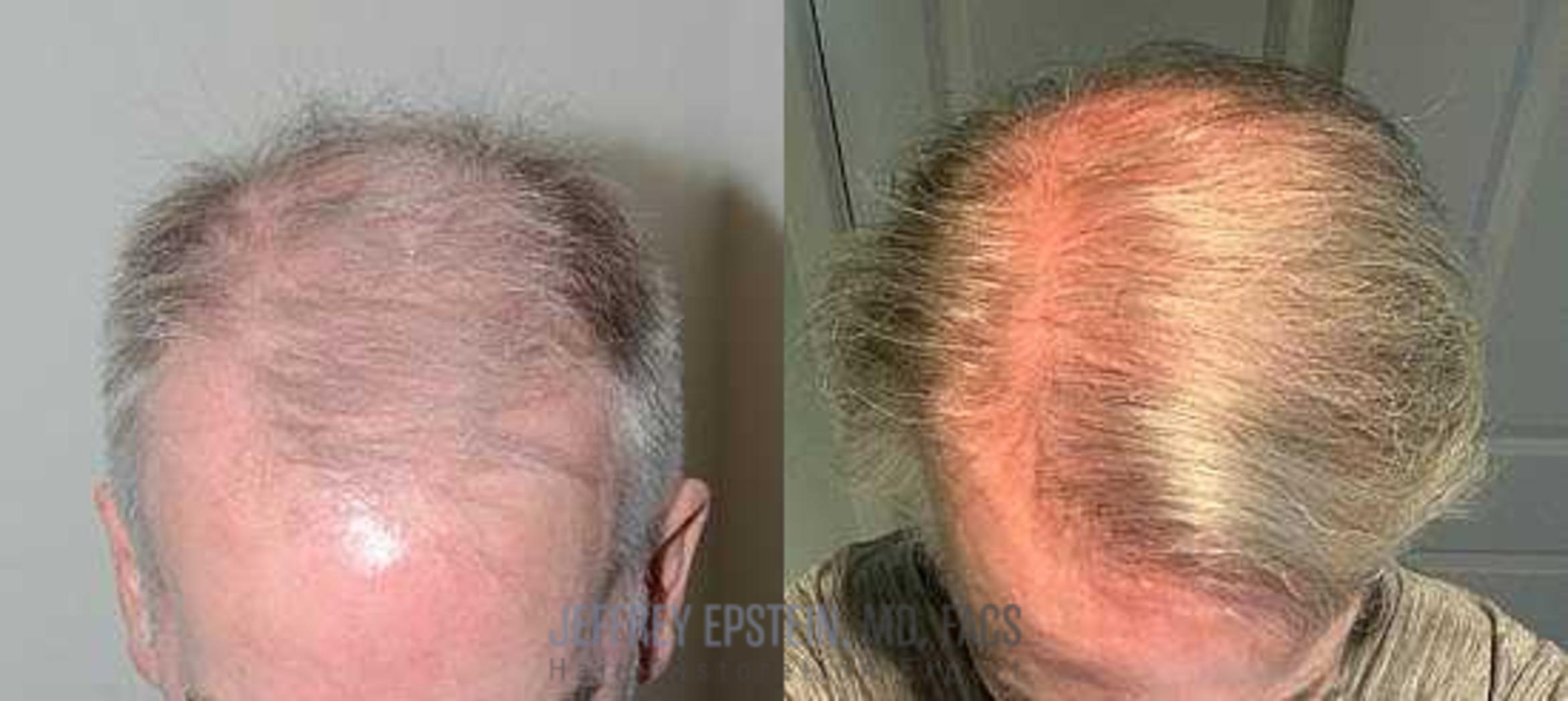 Before & After Hair Transplants For Men Case 97 View 2 View in Miami, FL