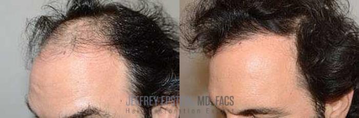 Before & After Hair Transplants For Men Case 98 View 1 View in Miami, FL