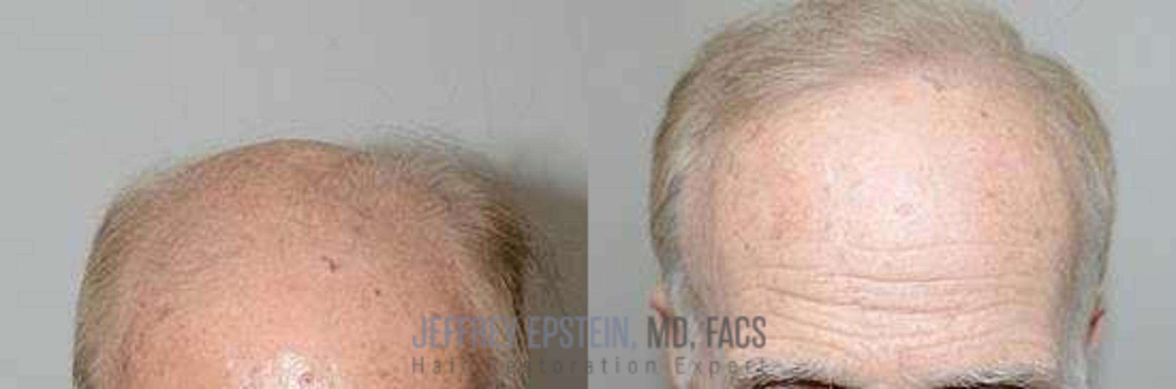 Before & After Hair Transplants For Men Case 99 View 1 View in Miami, FL
