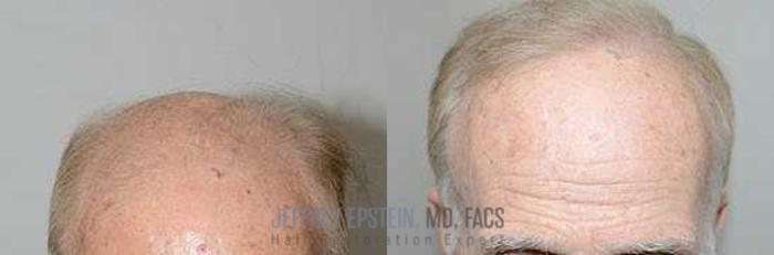 Before & After Hair Transplants For Men Case 99 View 1 View in Miami, FL