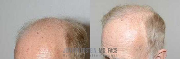 Before & After Hair Transplants For Men Case 99 View 2 View in Miami, FL