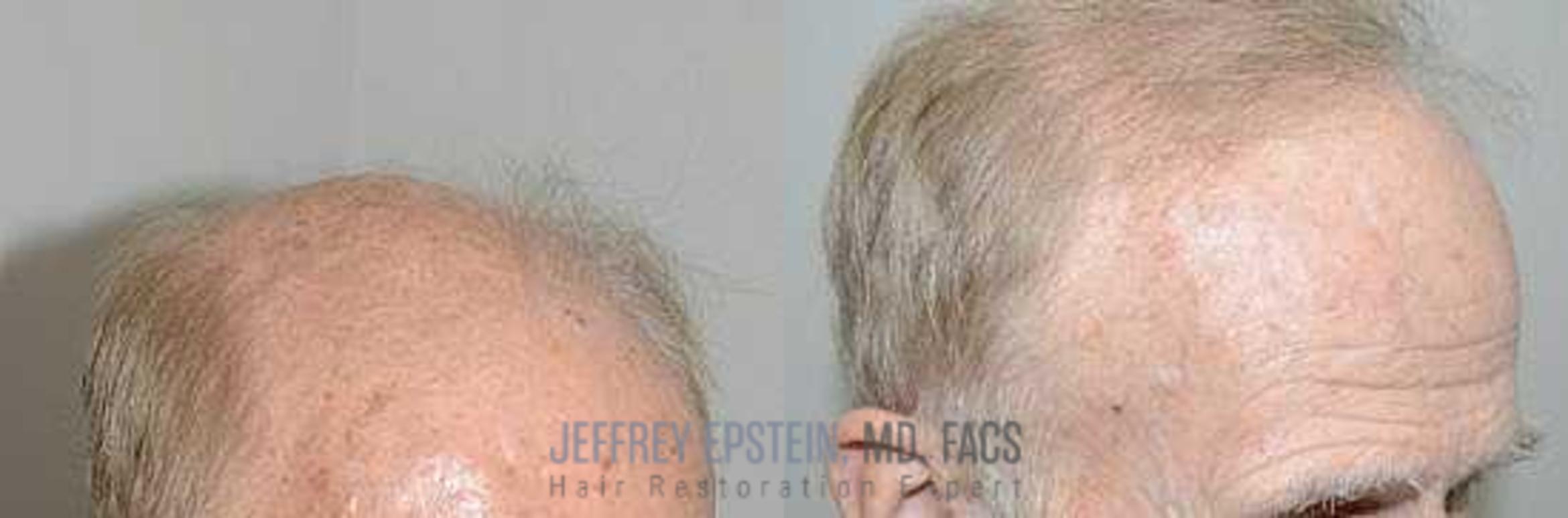 Before & After Hair Transplants For Men Case 99 View 3 View in Miami, FL