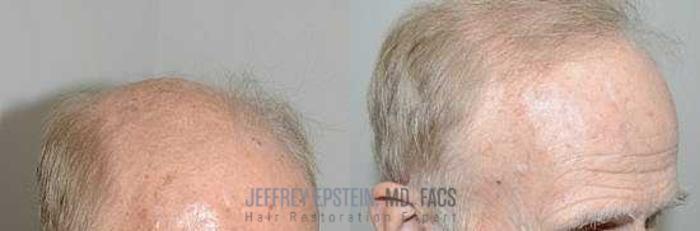 Before & After Hair Transplants For Men Case 99 View 3 View in Miami, FL