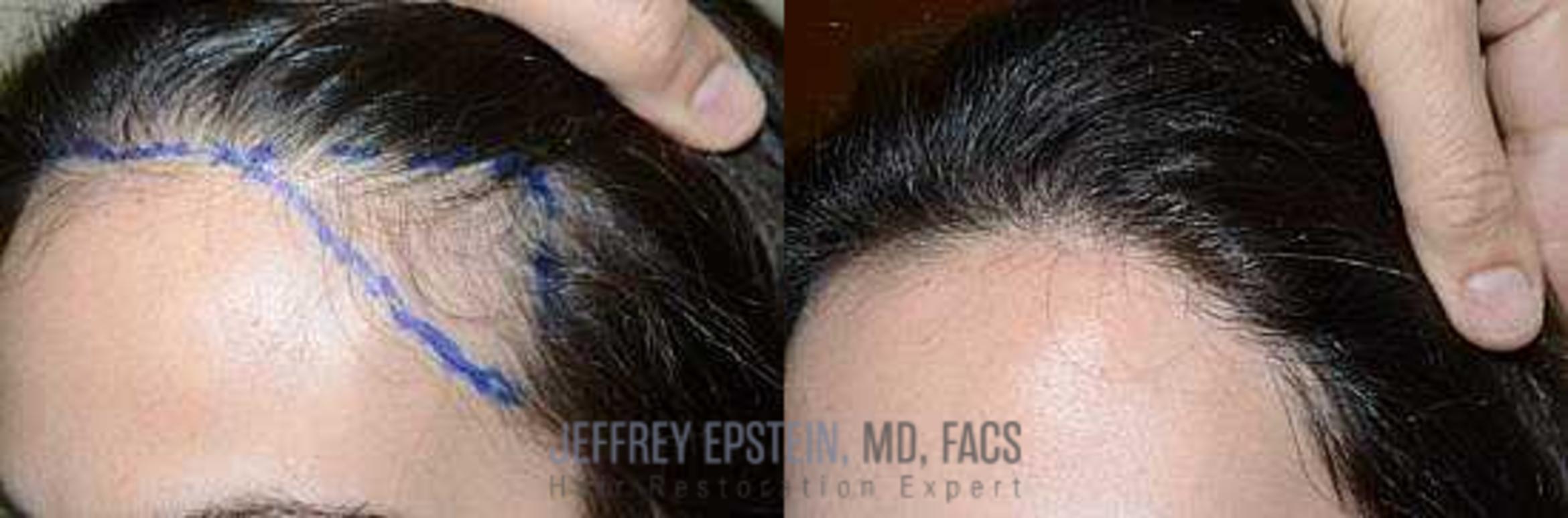 Before & After Hair Transplants For Women Case 159 View 2 View in Miami, FL