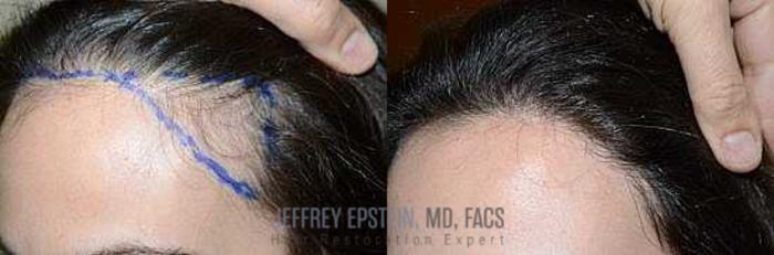 Before & After Hair Transplants For Women Case 159 View 2 View in Miami, FL