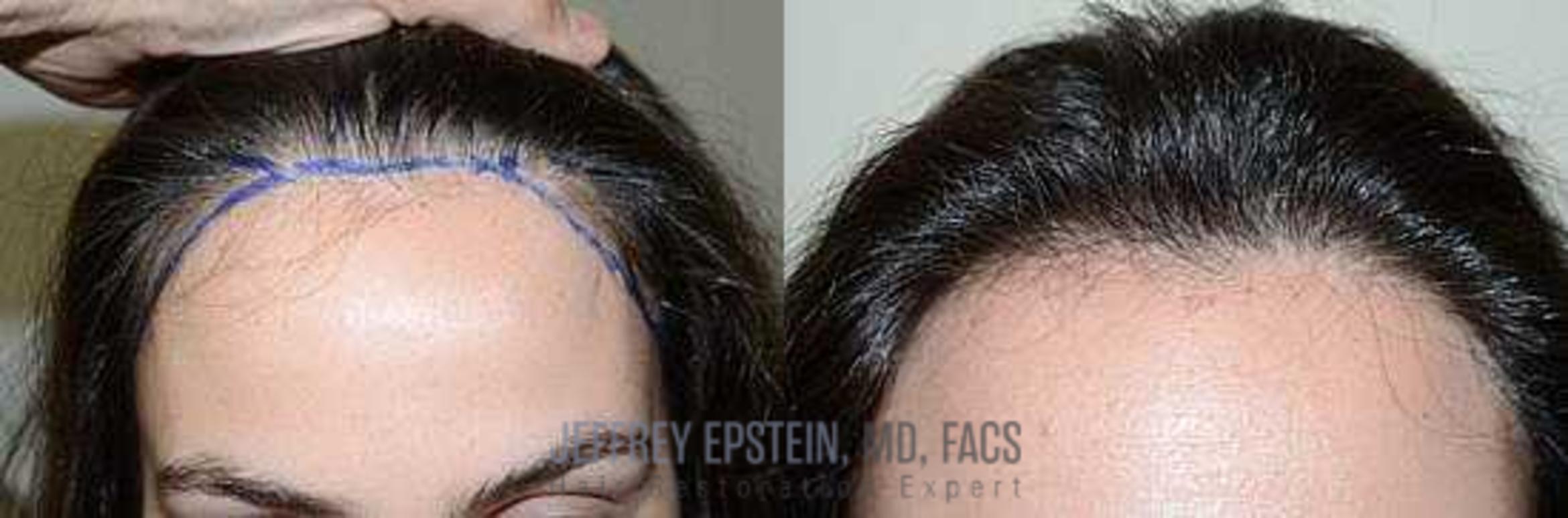 Before & After Hair Transplants For Women Case 159 View 3 View in Miami, FL