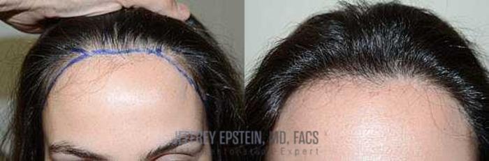 Before & After Hair Transplants For Women Case 159 View 3 View in Miami, FL