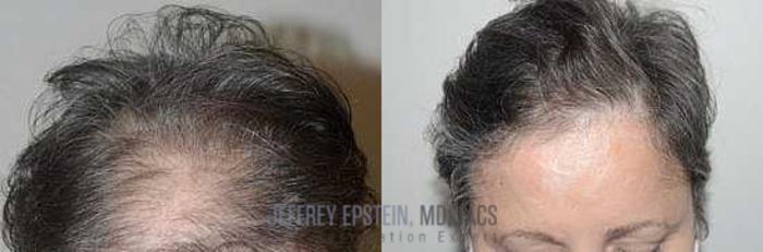 Before & After Hair Transplants For Women Case 162 View 1 View in Miami, FL