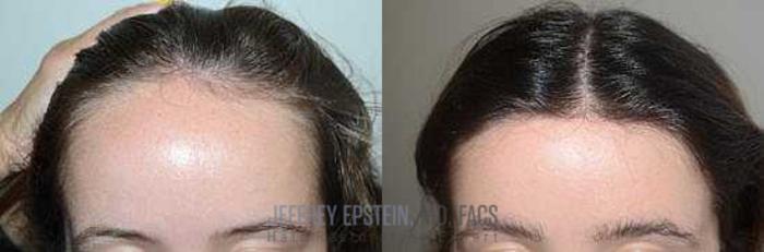 Before & After Hair Transplants For Women Case 163 View 1 View in Miami, FL