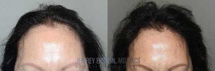 Before & After Hair Transplants For Women Case 164 View 1 View in Miami, FL
