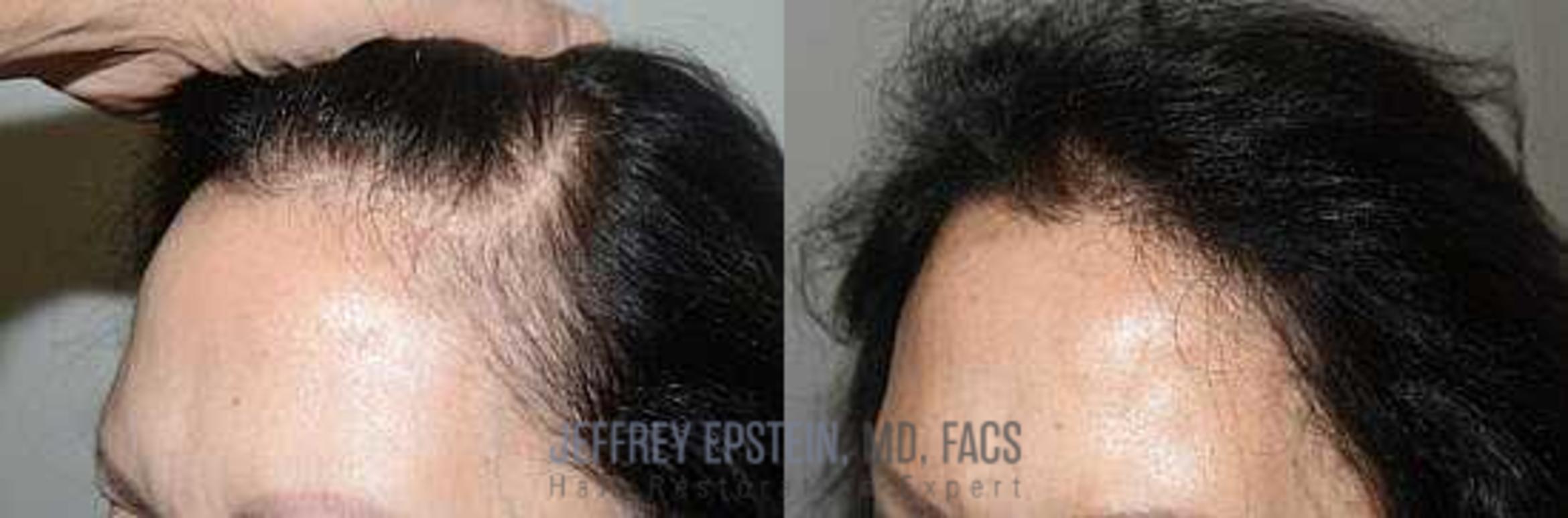 Before & After Hair Transplants For Women Case 164 View 2 View in Miami, FL