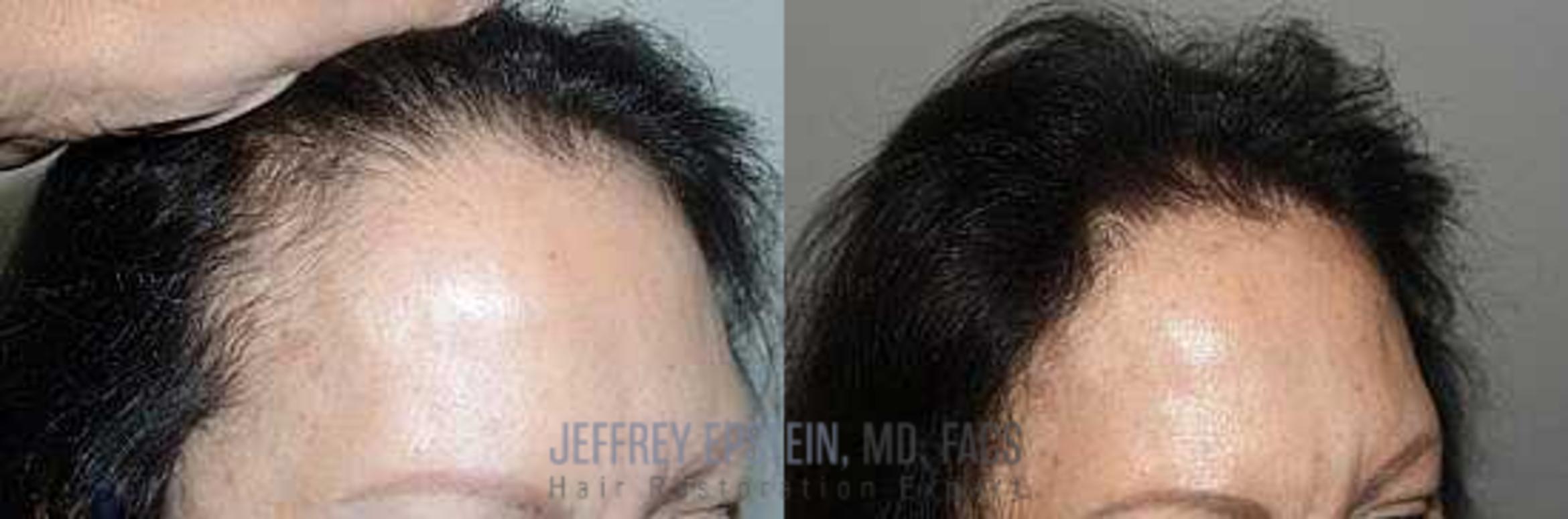 Before & After Hair Transplants For Women Case 164 View 3 View in Miami, FL