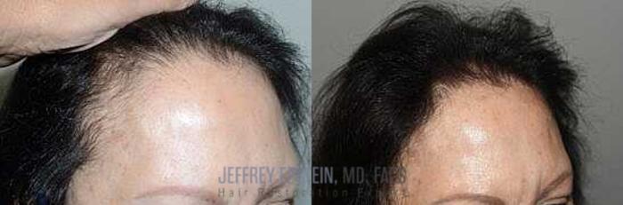 Before & After Hair Transplants For Women Case 164 View 3 View in Miami, FL