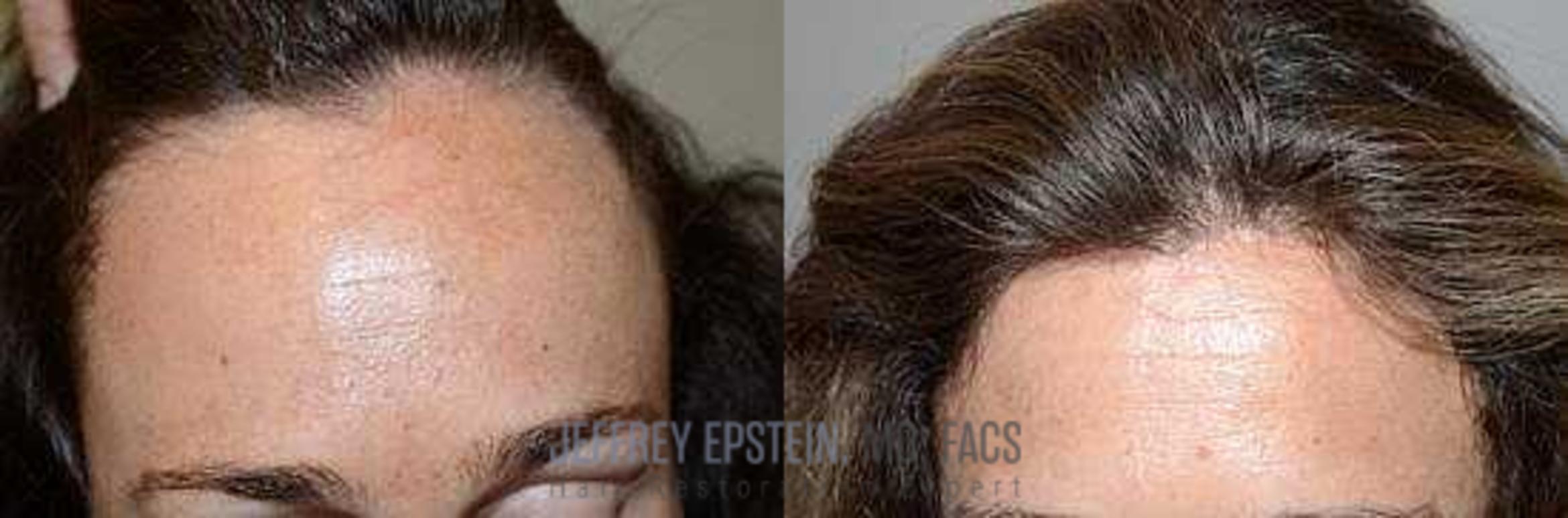 Before & After Hair Transplants For Women Case 165 View 2 View in Miami, FL