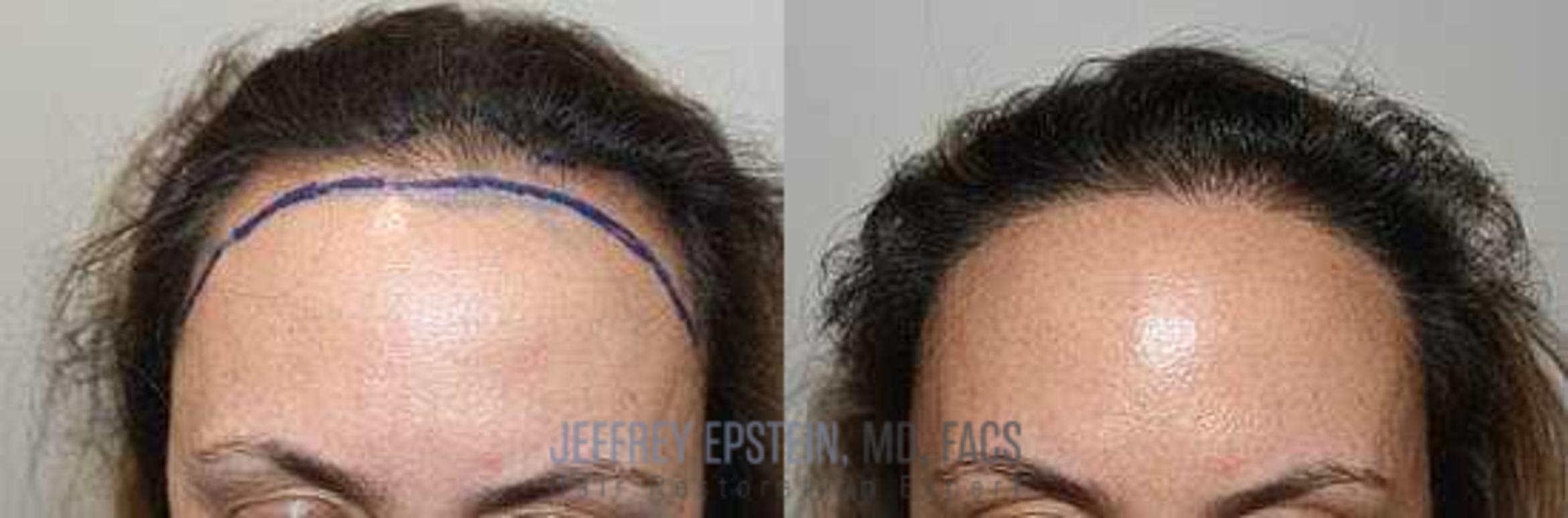 Before & After Hair Transplants For Women Case 168 View 1 View in Miami, FL