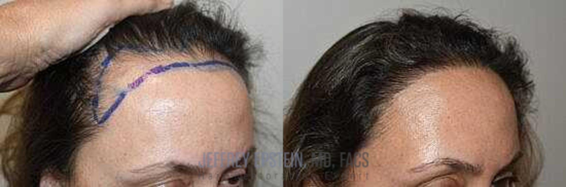 Before & After Hair Transplants For Women Case 168 View 2 View in Miami, FL