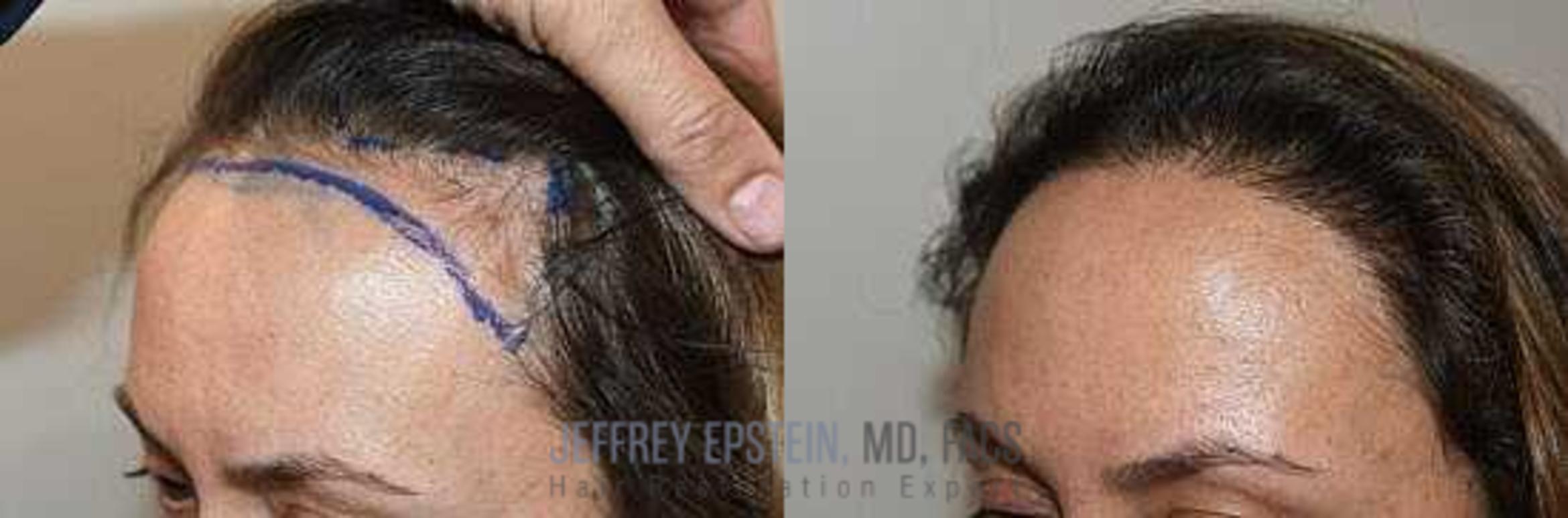 Before & After Hair Transplants For Women Case 168 View 3 View in Miami, FL