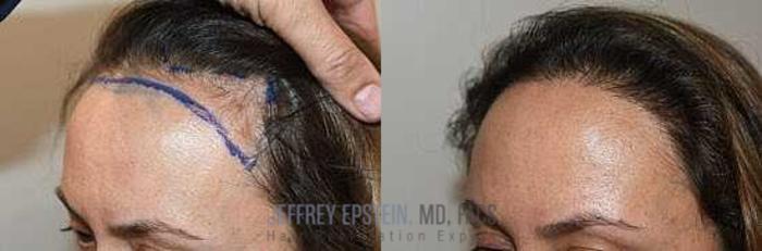 Before & After Hair Transplants For Women Case 168 View 3 View in Miami, FL