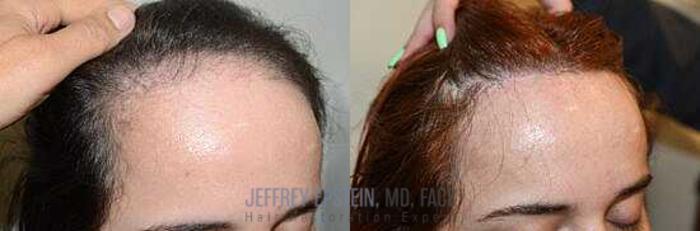 Before & After Hair Transplants For Women Case 169 View 1 View in Miami, FL