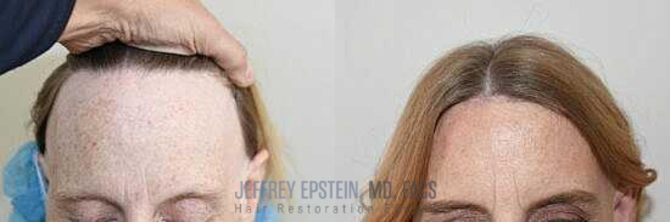 Before & After Hair Transplants For Women Case 171 View 2 View in Miami, FL