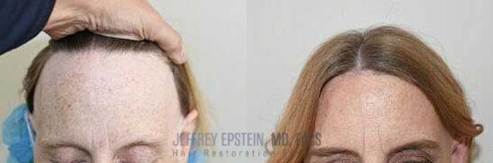Before & After Hair Transplants For Women Case 171 View 2 View in Miami, FL
