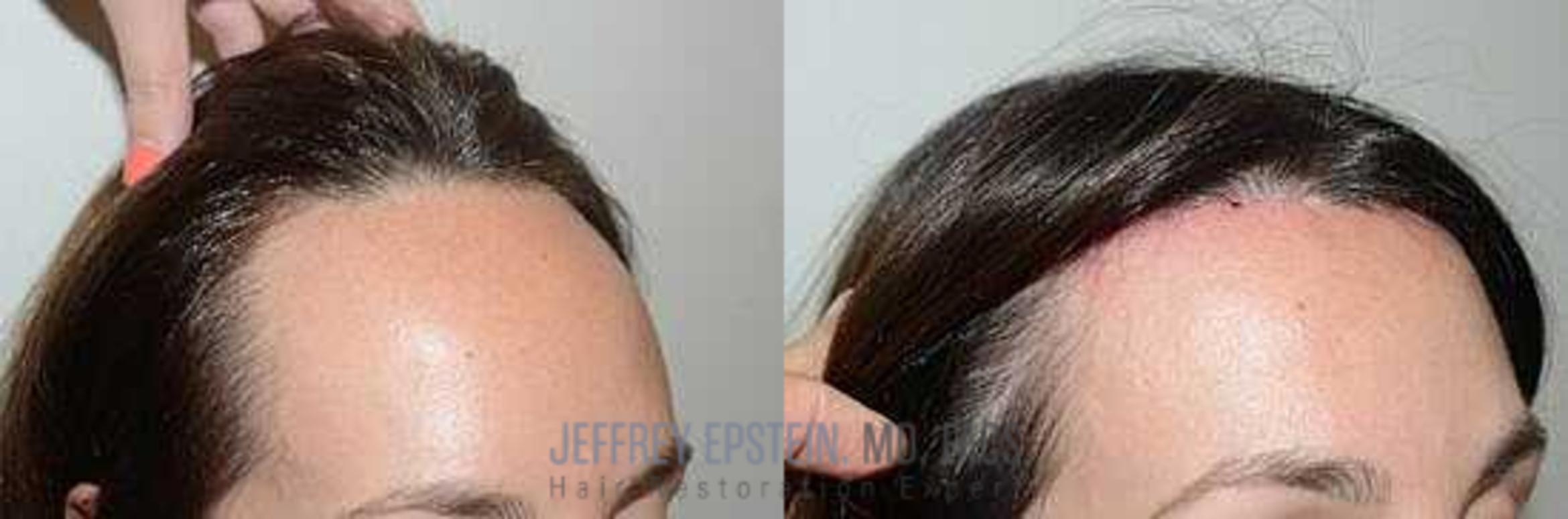 Before & After Hair Transplants For Women Case 173 View 1 View in Miami, FL